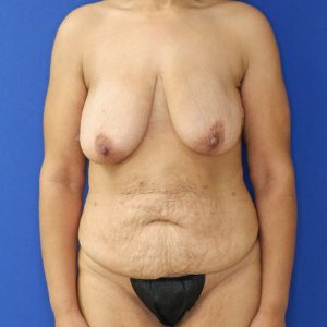 before mommy makeover front view female patient case 3955