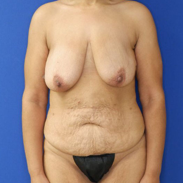 before mommy makeover front view female patient case 3955