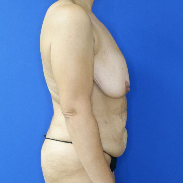 before mommy makeover right side view female patient case 3955
