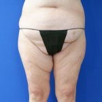 before mommy makeover lower legs front view female patient case 3966