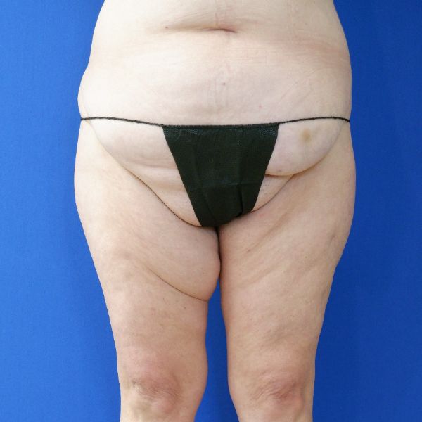 before mommy makeover lower legs front view female patient case 3966