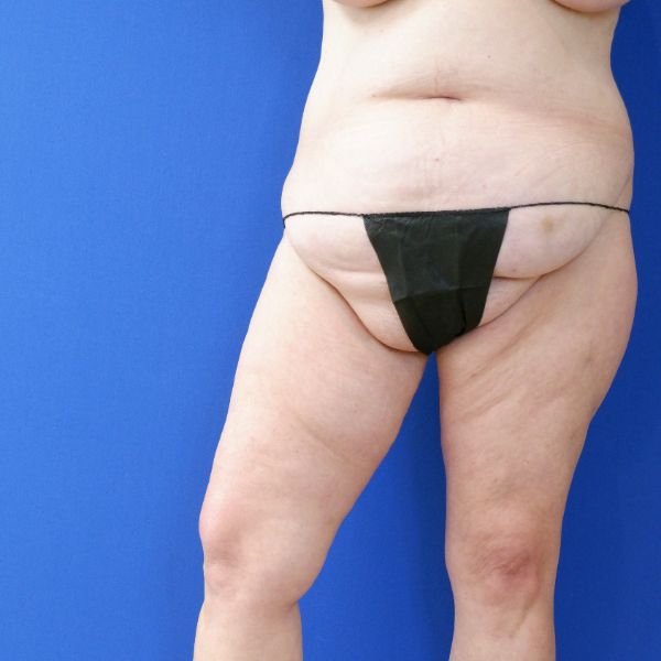 before mommy makeover lower legs open right view female patient case 3966