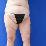 before mommy makeover lower legs open left view female patient case 3966