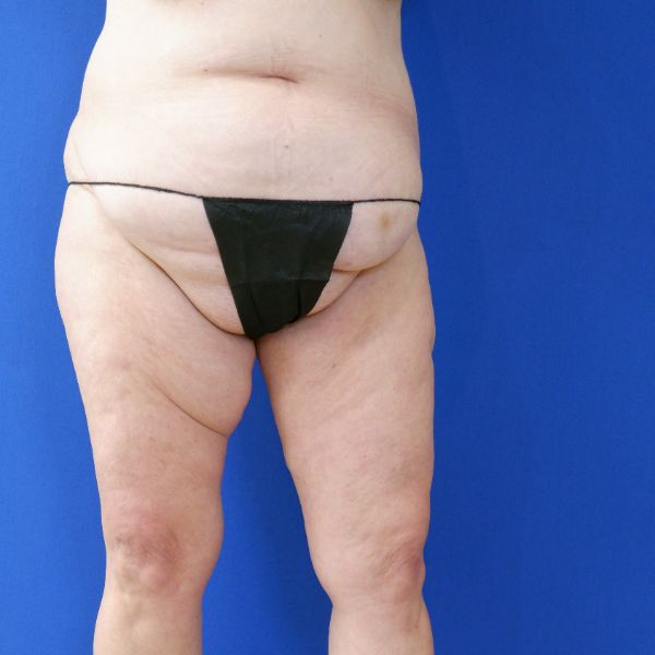 before mommy makeover lower legs open left view female patient case 3966