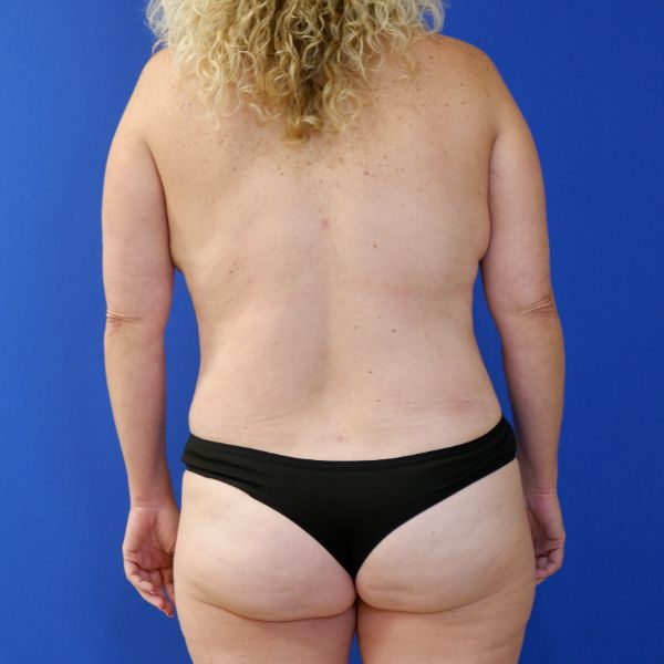after mommy makeover back view female patient case 3966