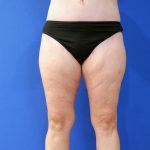 after mommy makeover lower legs front view female patient case 3966