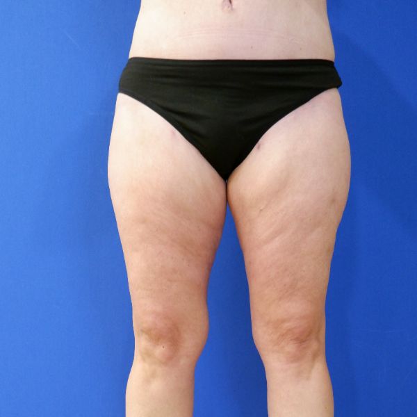 after mommy makeover lower legs front view female patient case 3966