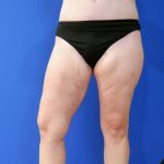 after mommy makeover lower legs open right view female patient case 3966