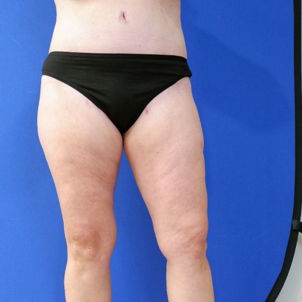 before mommy makeover lower legs open left view female patient case 3966