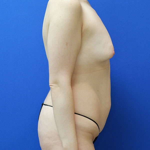 before mommy makeover right side view female patient case 3985