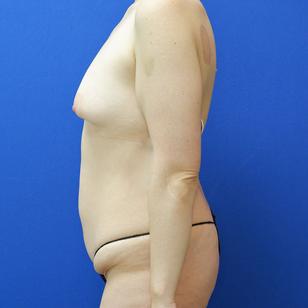 before mommy makeover left side view female patient case 3985