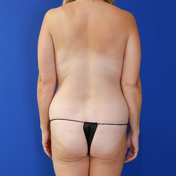 before tummy tuck back view of female patient 3915