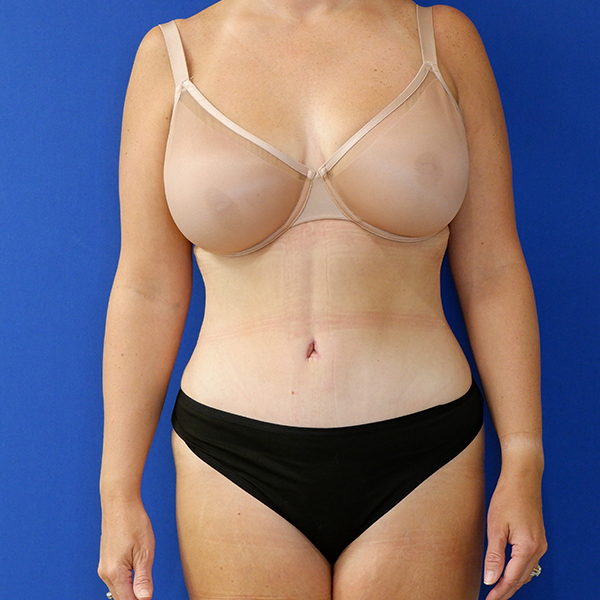 after tummy tuck front view of female patient 3915