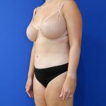 after tummy tuck left angle view of female patient 3915