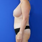 after tummy tuck left side view of female patient 3915