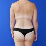 after tummy tuck back view of female patient 3915