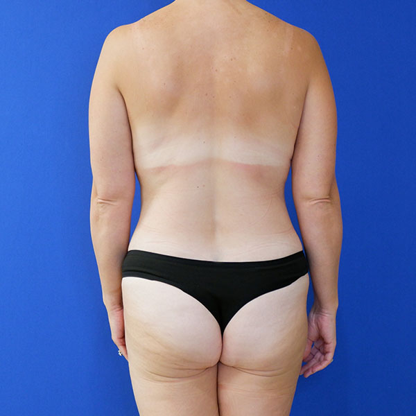 after tummy tuck back view of female patient 3915