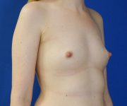 before breast augmentation right angle view female patient case 4282
