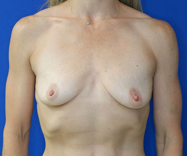 before breast augmentation front view female patient case 4288