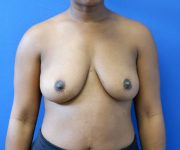 before breast augmentation front view female patient case 4295