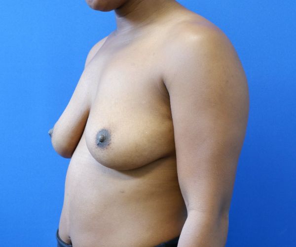 before breast augmentation left angle view female patient case 4295