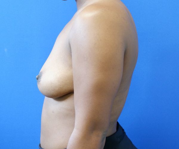 before breast augmentation left side view female patient case 4295