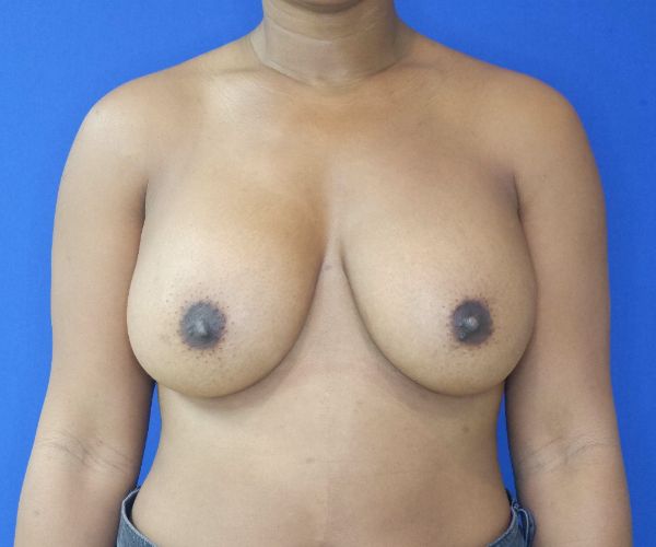 after breast augmentation front view female patient case 4295
