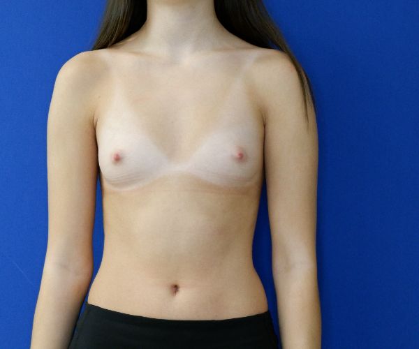 before breast augmentation front view female patient case 4418