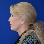 before facelift and neck lift left side view of female patient 4478