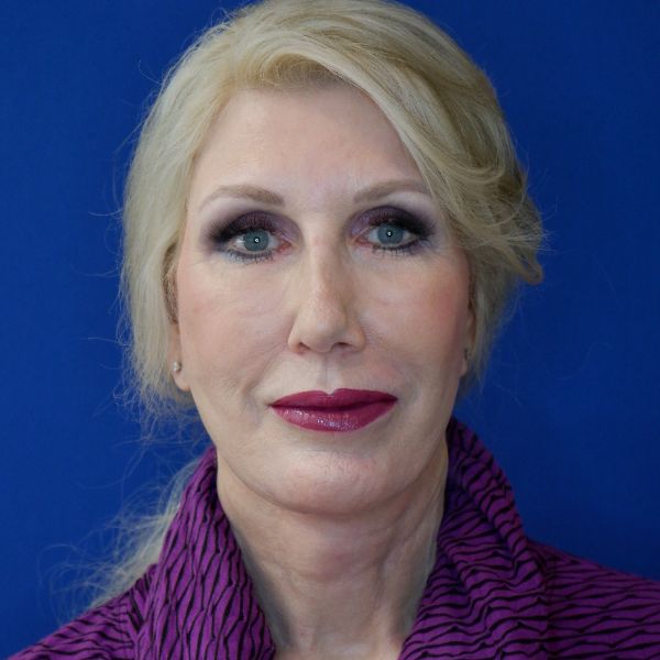 after facelift and neck lift front view of female patient 4478