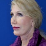 after facelift and neck lift left angle view of female patient 4478