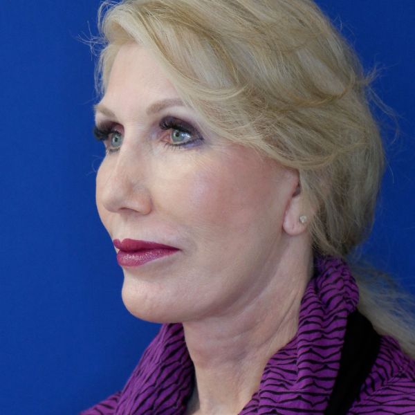 after facelift and neck lift left angle view of female patient 4478