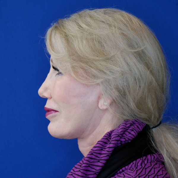 after facelift and neck lift left side view of female patient 4478