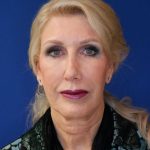 before facelift and neck lift front view of female patient 4478