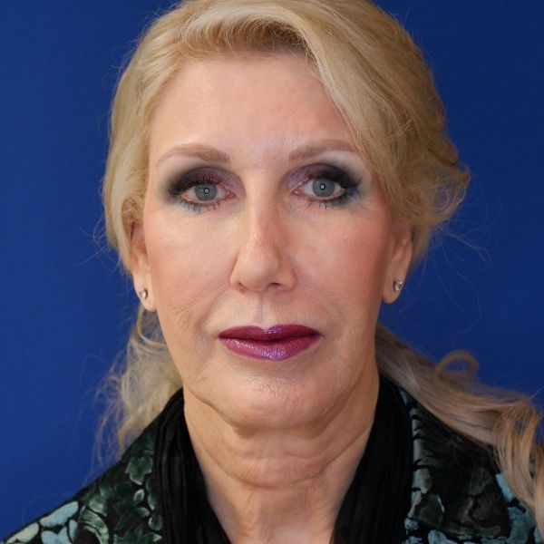 before facelift and neck lift front view of female patient 4478