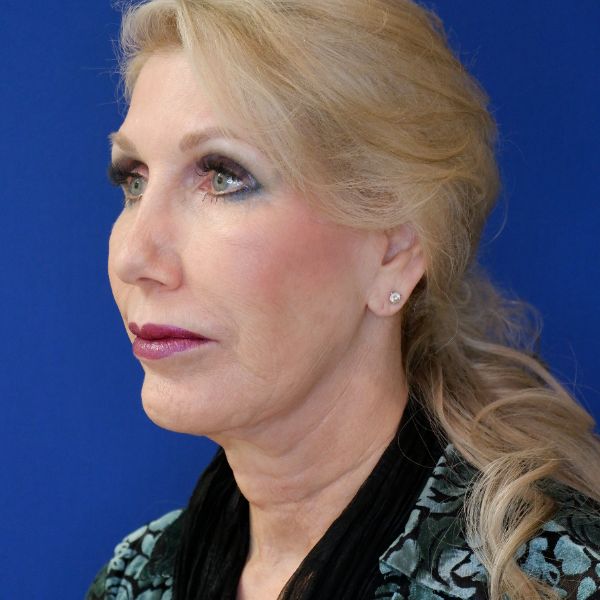 before facelift and neck lift left angle view of female patient 4478