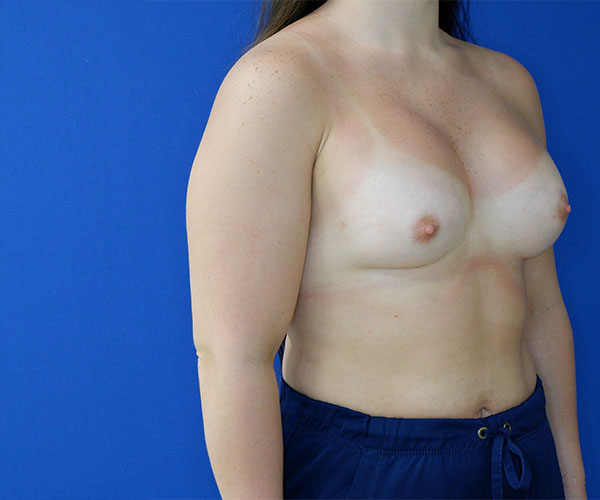 after breast augmentation right angle view of female patient 4579