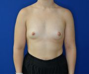 before breast augmentation front view of female patient 4579
