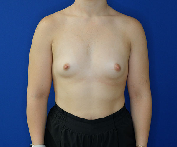 before breast augmentation front view of female patient 4579