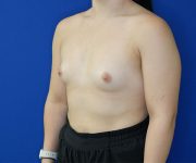 before breast augmentation left angle view of female patient 4579