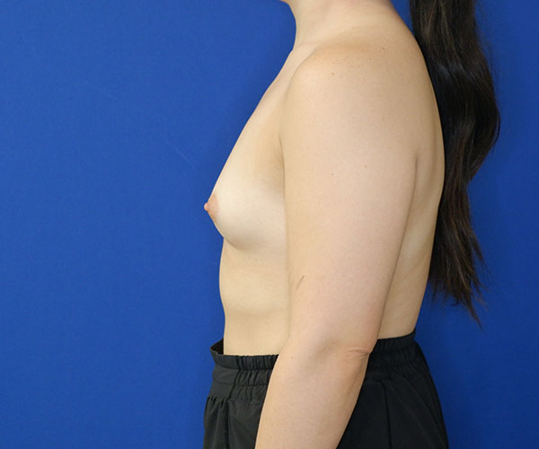 before breast augmentation left side view of female patient 4579