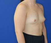 before breast augmentation right angle view of female patient 4579
