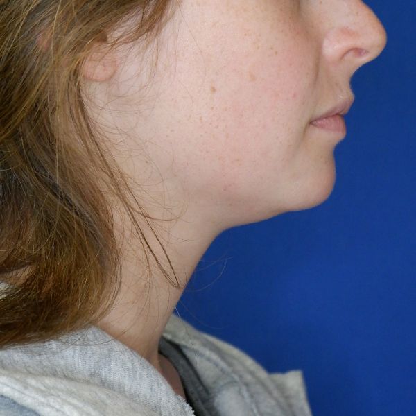before submental chin liposuction right side view of female patient 4568