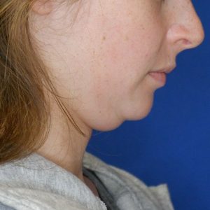 before submental chin liposuction right downward side view of female patient 4568
