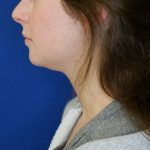 before submental chin liposuction left side view of female patient 4568