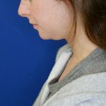 before submental chin liposuction left downward side view of female patient 4568