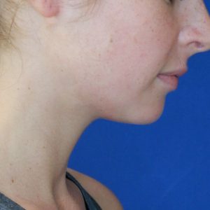 after submental chin liposuction right downward side view of female patient 4568
