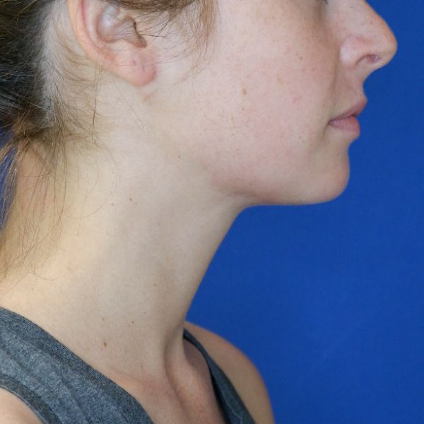 after submental chin liposuction right side view of female patient 4568