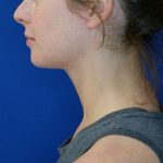 after submental chin liposuction left lower side view of female patient 4568