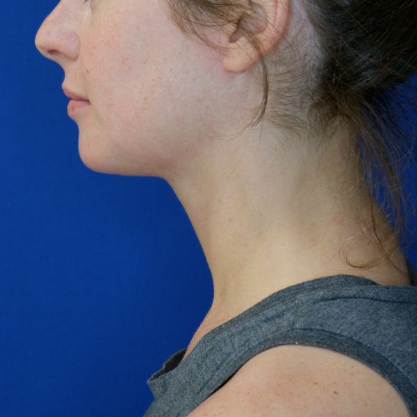 after submental chin liposuction left lower side view of female patient 4568